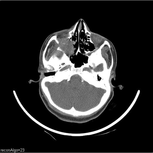 Carcinoma of the maxillary antrum (Radiopaedia 53805-59888 Axial non-contrast 66).jpg