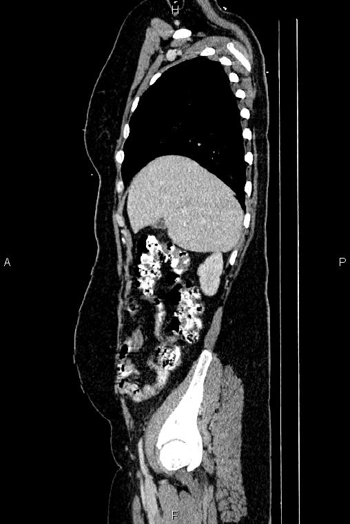 Carcinoma of uterine cervix (Radiopaedia 85861-101700 D 15).jpg