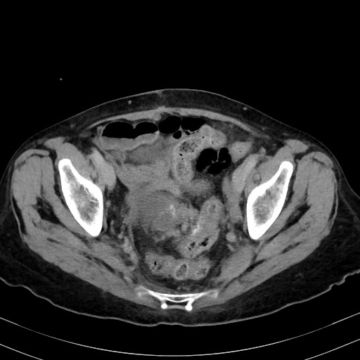 Carcinosarcoma (Radiopaedia 70401-80503 A 57).jpg