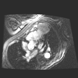 File:Cardiac fibroma (Radiopaedia 38974-41150 4 chamber FGRET 10).jpg