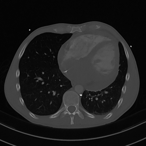File:Cardiac tumor - undifferentiated pleomorphic sarcoma (Radiopaedia 45844-50134 Axial bone window 47).png