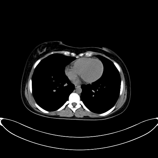 Caroli disease with medullary sponge kidney (Radiopaedia 82622-96804 Axial non-contrast 4).jpg