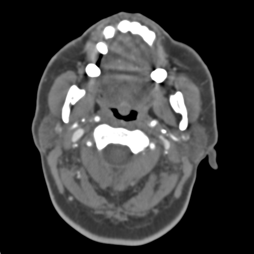 File:Carotico ophthalmic aneurysm (Radiopaedia 42916-46148 A 55).png