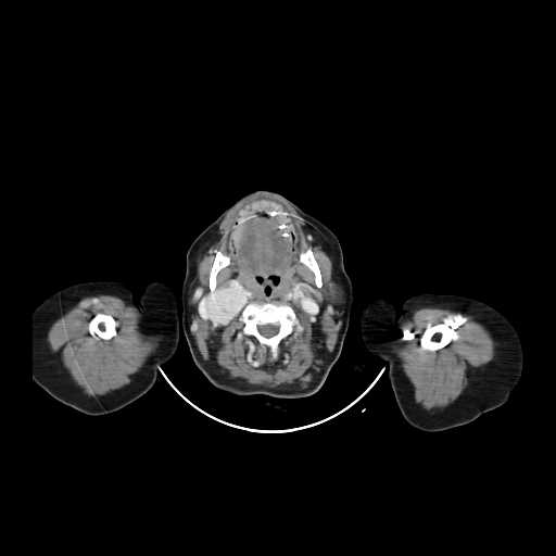 File:Carotid body tumor (Radiopaedia 21021-20948 B 10).jpg
