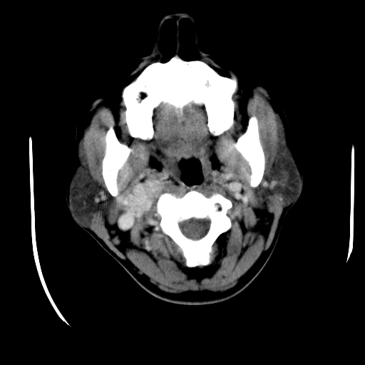 File:Carotid body tumor (Radiopaedia 27890-28124 A 9).jpg