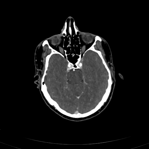 File:Carotid body tumor (Radiopaedia 83615-98727 A 8).jpg