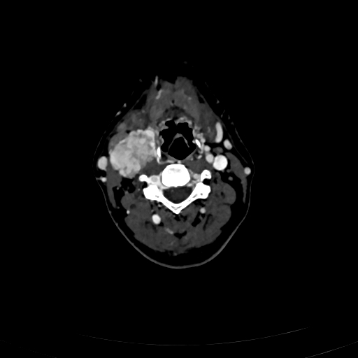 Carotid body tumor (Radiopaedia 83615-98727 D 60).jpg