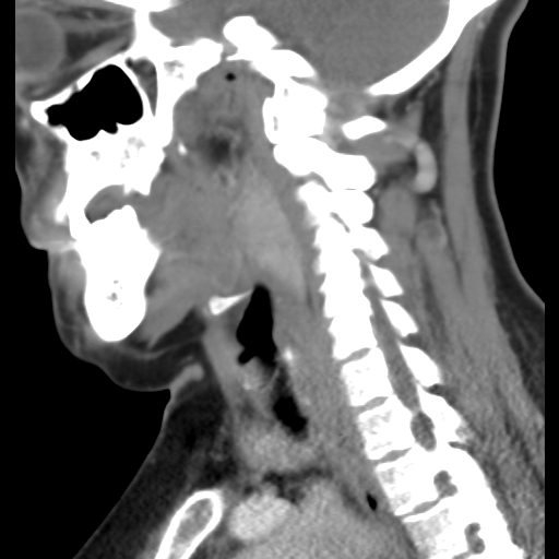 File:Carotid body tumor (paraganglioma) (Radiopaedia 38586-40729 C 18).jpg