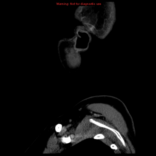 Carotid body tumor with lung metastases (Radiopaedia 9301-9986 Sagittal C+ delayed 53).jpg