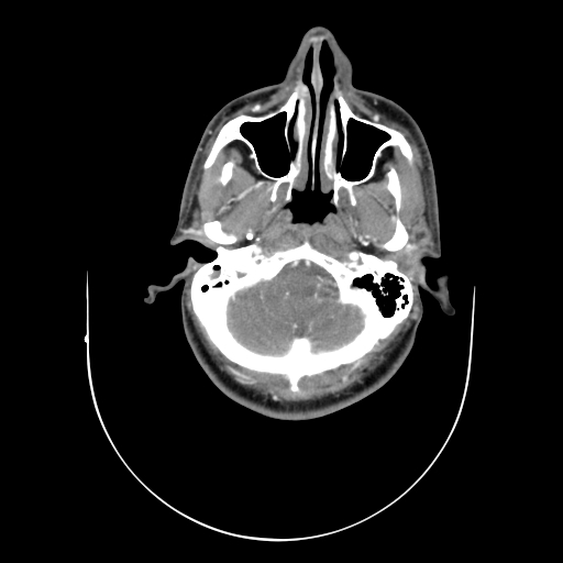 File:Carotid bulb pseudoaneurysm (Radiopaedia 57670-64616 A 2).jpg