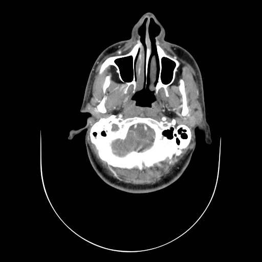 File:Carotid bulb pseudoaneurysm (Radiopaedia 57670-64616 A 5).jpg