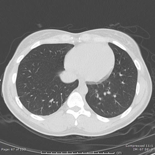 Catamenial pneumothorax (Radiopaedia 54382-60600 Axial non-contrast 67).jpg
