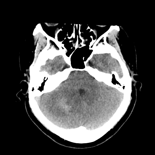 Cavernoma with hemorrhage (Radiopaedia 70755-80931 Axial non-contrast 16).png