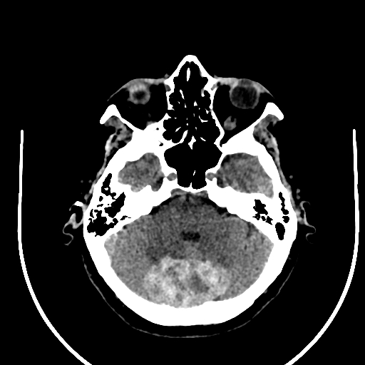 Cavernous hemangioma of the cerebellar falx (Radiopaedia 73025-83723 Axial non-contrast 36).jpg