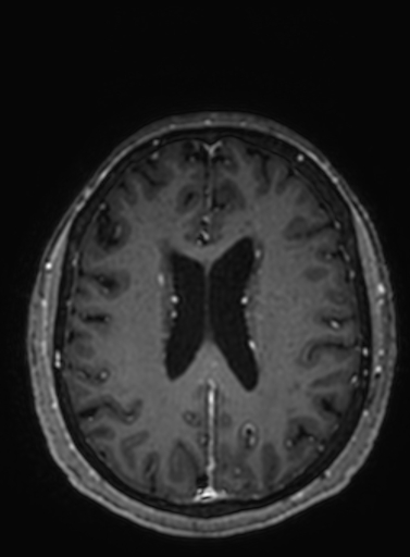 Cavernous hemangioma of the cerebellar falx (Radiopaedia 73025-83724 Axial T1 C+ 122).jpg