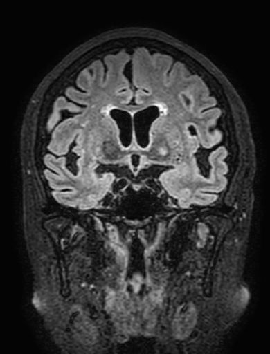 Cavernous hemangioma of the cerebellar falx (Radiopaedia 73025-83724 Coronal FLAIR 142).jpg