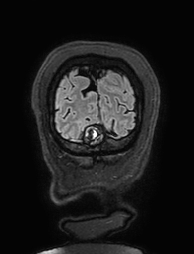 Cavernous hemangioma of the cerebellar falx (Radiopaedia 73025-83724 Coronal FLAIR 332).jpg