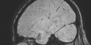 File:Cavernous hemangioma of the cerebellar falx (Radiopaedia 73025-83724 Sagittal BOLD 152).jpg