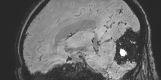 Cavernous hemangioma of the cerebellar falx (Radiopaedia 73025-83724 Sagittal BOLD 84).jpg