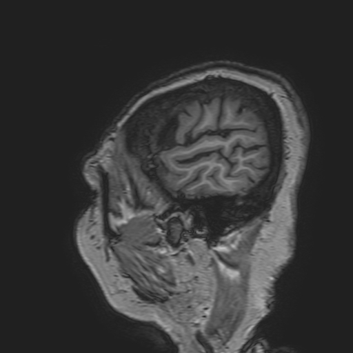 File:Cavernous hemangioma of the cerebellar falx (Radiopaedia 73025-83724 Sagittal T1 25).jpg