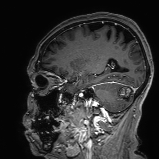 Cavernous hemangioma of the cerebellar falx (Radiopaedia 73025-83724 Sagittal T1 C+ 142).jpg