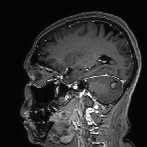 Cavernous hemangioma of the cerebellar falx (Radiopaedia 73025-83724 Sagittal T1 C+ 70).jpg