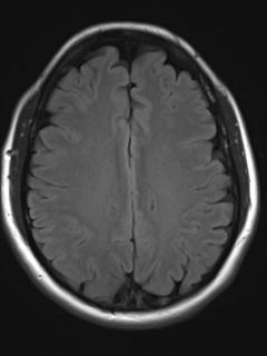 File:Cavernous malformation (cavernous angioma or cavernoma) (Radiopaedia 36675-38237 Axial T2 FLAIR 15).png