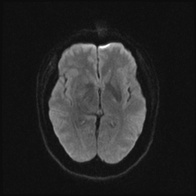 Cavernous sinus meningioma (Radiopaedia 63682-72367 DWI 32).jpg