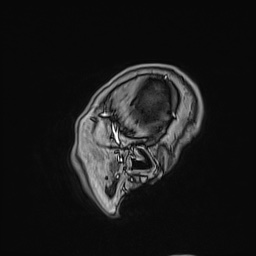 Cavernous sinus meningioma (Radiopaedia 63682-72367 Sagittal T1 C+ 159).jpg