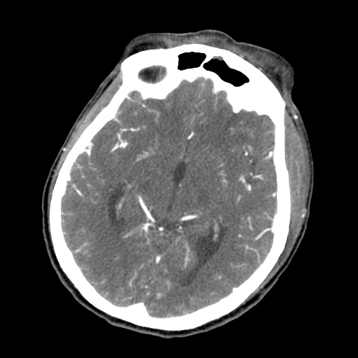 File:Cavernous sinus thrombosis (Radiopaedia 10619-11078 A 1).jpg