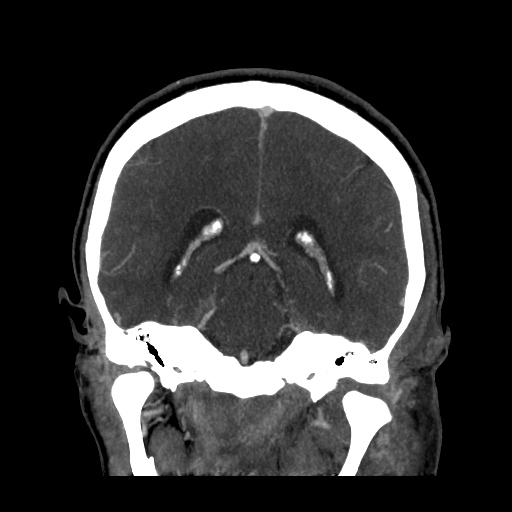 File:Cavernous sinus thrombosis (Radiopaedia 10619-11078 D 19).jpg
