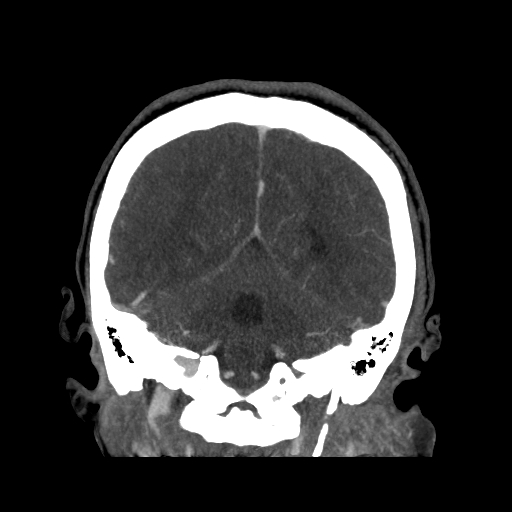 File:Cavernous sinus thrombosis (Radiopaedia 10619-11078 D 23).jpg