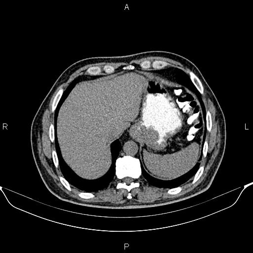 Cecal adenocarcinoma (Radiopaedia 85324-100916 Axial non-contrast 13).jpg