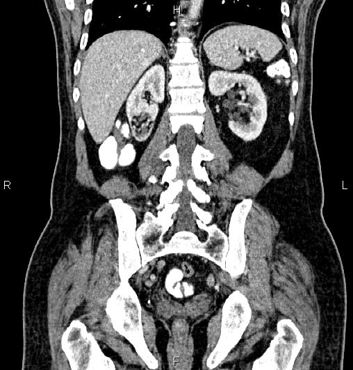 Cecal adenocarcinoma (Radiopaedia 85324-100916 D 47).jpg