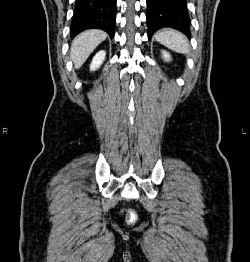 Cecal adenocarcinoma (Radiopaedia 85324-100916 D 59).jpg