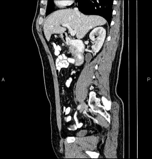 Cecal adenocarcinoma (Radiopaedia 85324-100916 E 34).jpg