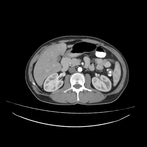 Cecal carcinoma with local lymphadenopathy (Radiopaedia 31428-32240 A 19).jpg