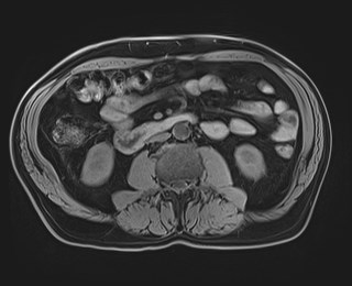 Cecal mass causing appendicitis (Radiopaedia 59207-66532 Axial T1 72).jpg
