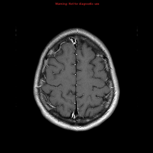 File:Central nervous system vasculitis (Radiopaedia 8410-9235 Axial T1 C+ 20).jpg