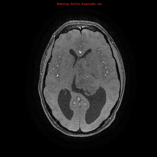 Central neurocytoma (Radiopaedia 13188-13206 Axial MRA 44).jpg