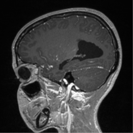 Central neurocytoma (Radiopaedia 37664-39557 Sagittal T1 C+ 31).png