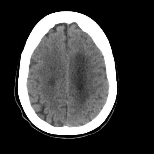Central neurocytoma (Radiopaedia 65317-74346 Axial non-contrast 37).png