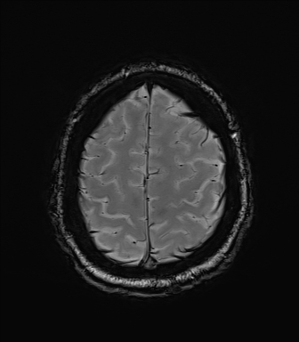 File:Central neurocytoma (Radiopaedia 71068-81303 Axial SWI 56).jpg