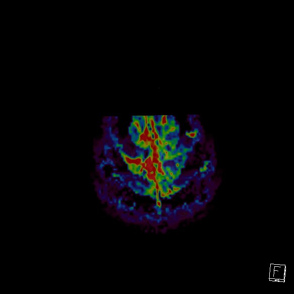 Central neurocytoma (Radiopaedia 84497-99872 Axial Perfusion 13).jpg