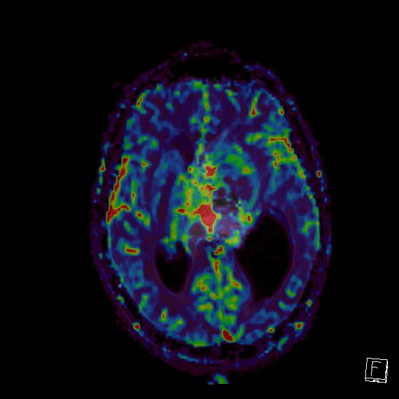 Central neurocytoma (Radiopaedia 84497-99872 Axial Perfusion 156).jpg
