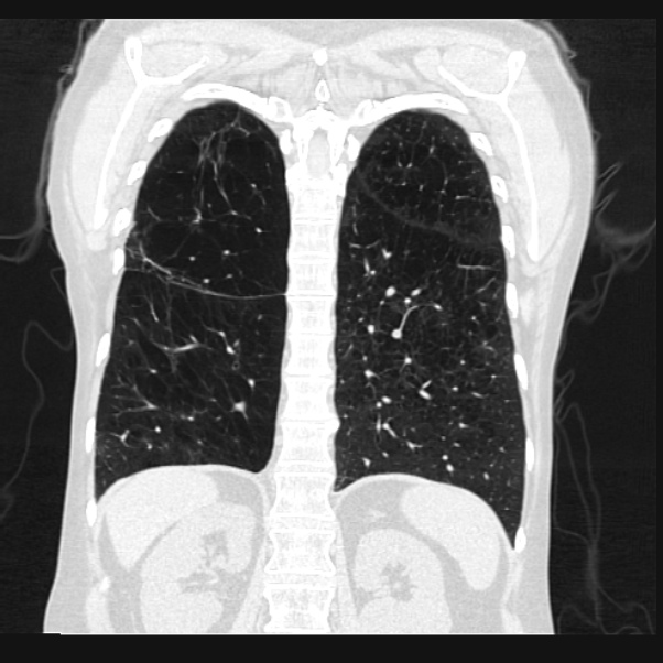 Centrilobular pulmonary emphysema (Radiopaedia 24495-24789 Coronal lung window 56).jpg