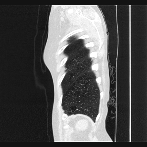 Centrilobular pulmonary emphysema (Radiopaedia 24495-24789 Sagittal lung window 79).jpg