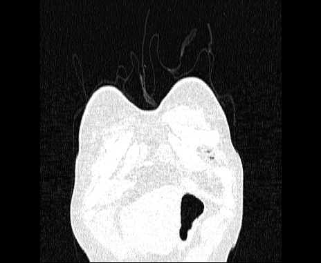 Centrilobular pulmonary emphysema (Radiopaedia 62468-70718 Coronal lung window 4).jpg