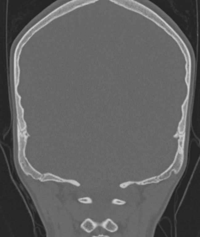 Cerebellar abscess (Radiopaedia 73727-84527 Coronal bone window 18).jpg