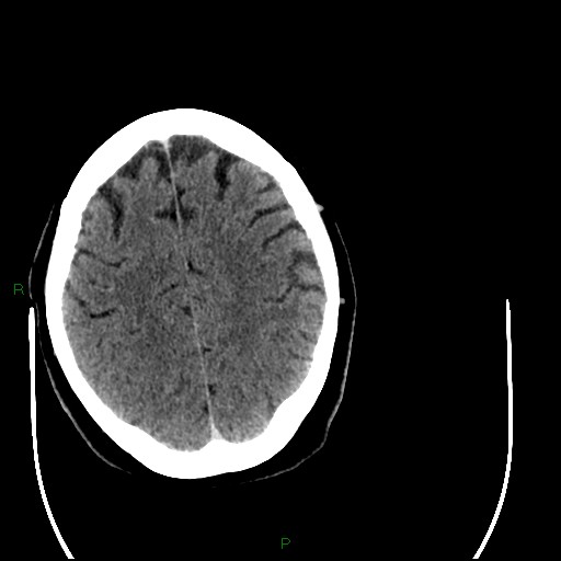 Cerebellar abscess (Radiopaedia 78135-90671 Axial C+ delayed 81).jpg
